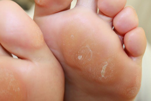 Some corns and callus on the base of a foot.